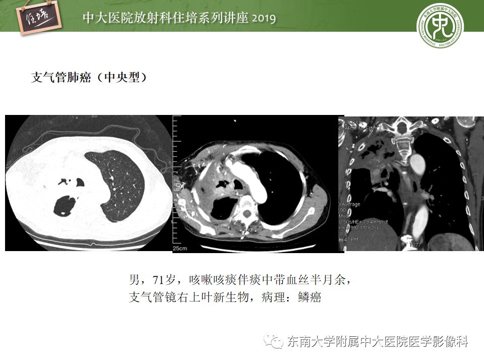 【PPT】咯血的临床及影像分析思路