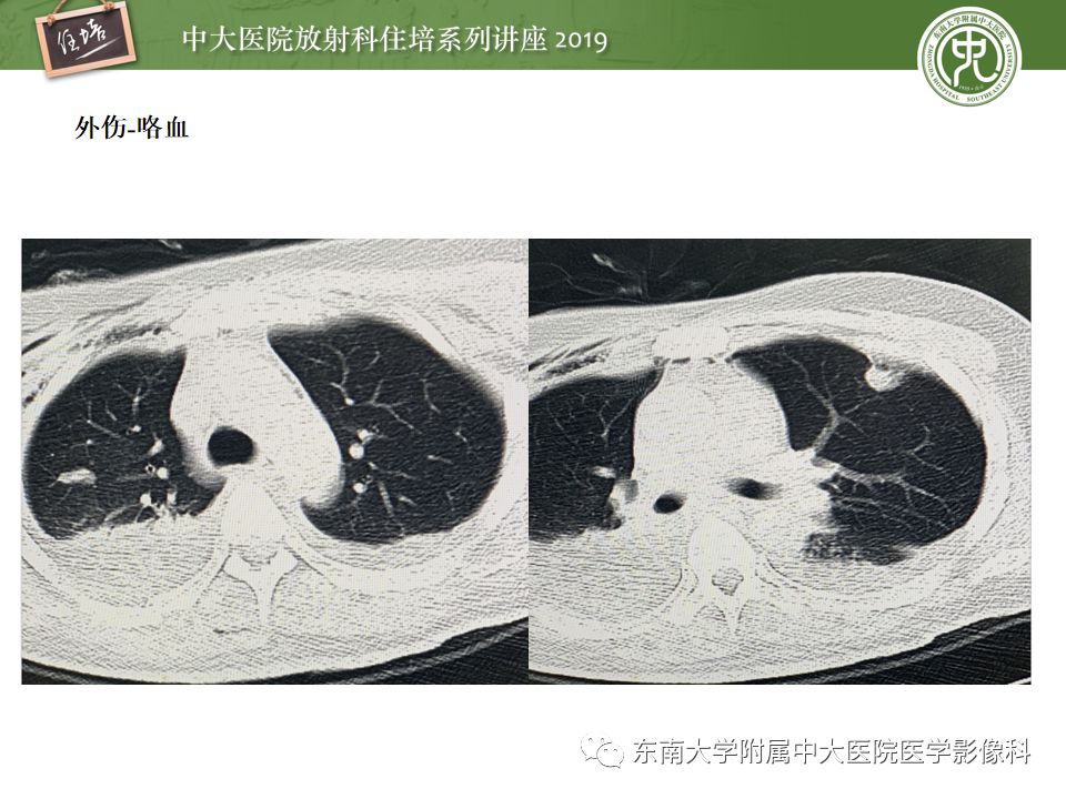 【PPT】咯血的临床及影像分析思路