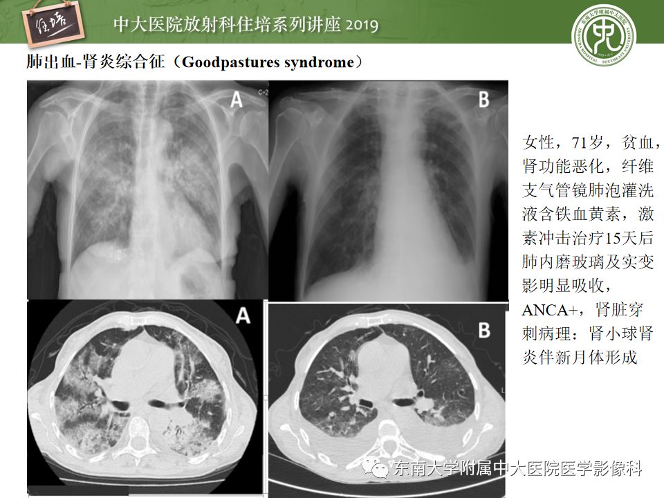【PPT】咯血的临床及影像分析思路