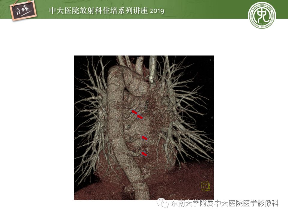 【PPT】咯血的临床及影像分析思路