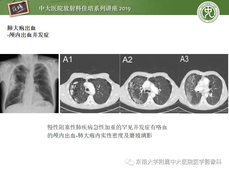【PPT】咯血的临床及影像分析思路