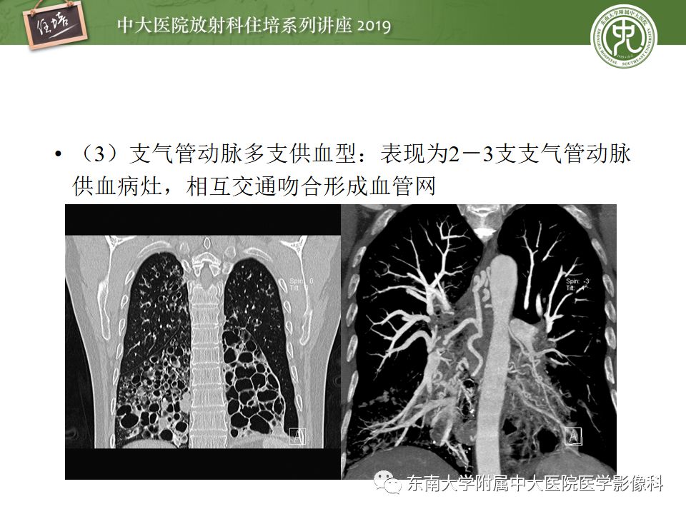 【PPT】咯血的临床及影像分析思路