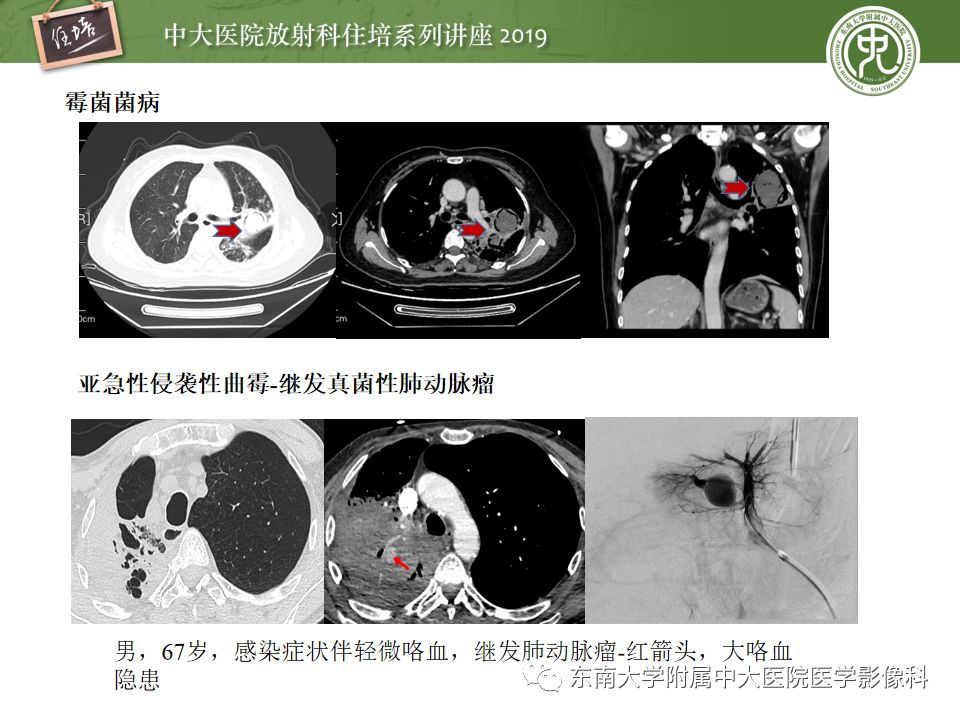 【PPT】咯血的临床及影像分析思路