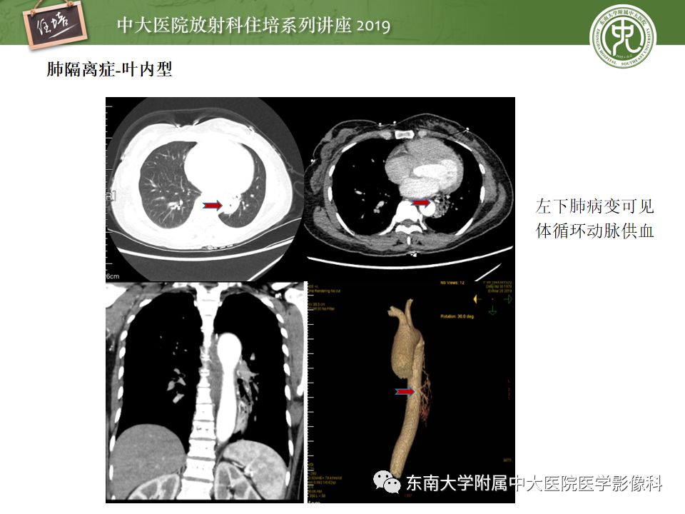【PPT】咯血的临床及影像分析思路