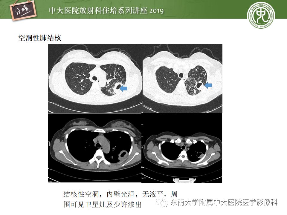 【PPT】咯血的临床及影像分析思路
