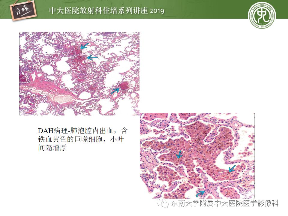 【PPT】咯血的临床及影像分析思路