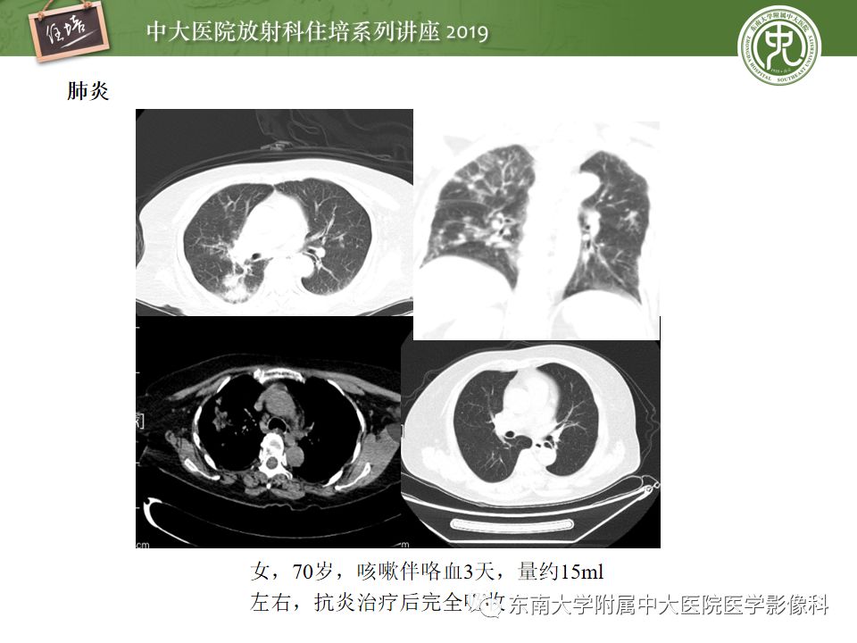 【PPT】咯血的临床及影像分析思路
