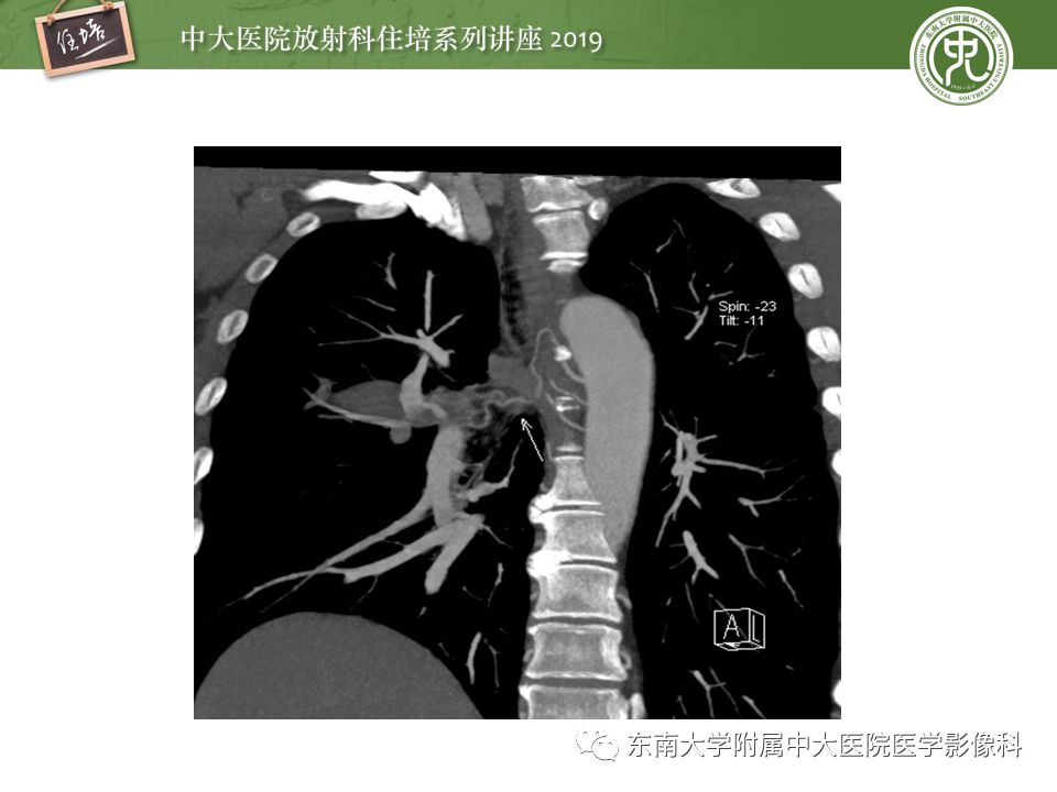 【PPT】咯血的临床及影像分析思路