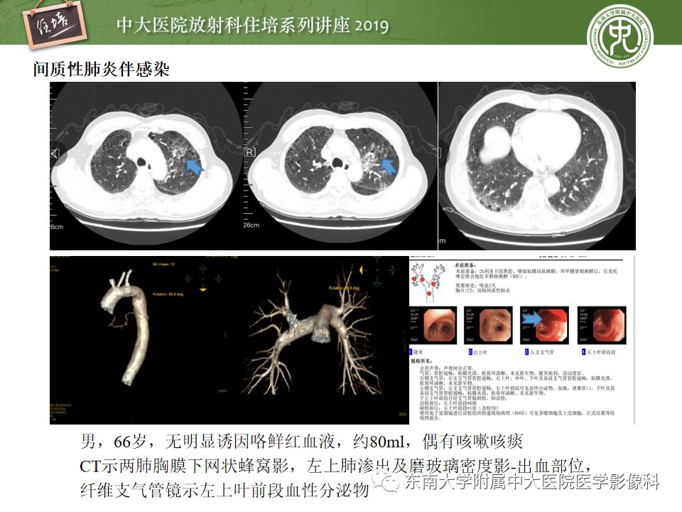 【PPT】咯血的临床及影像分析思路