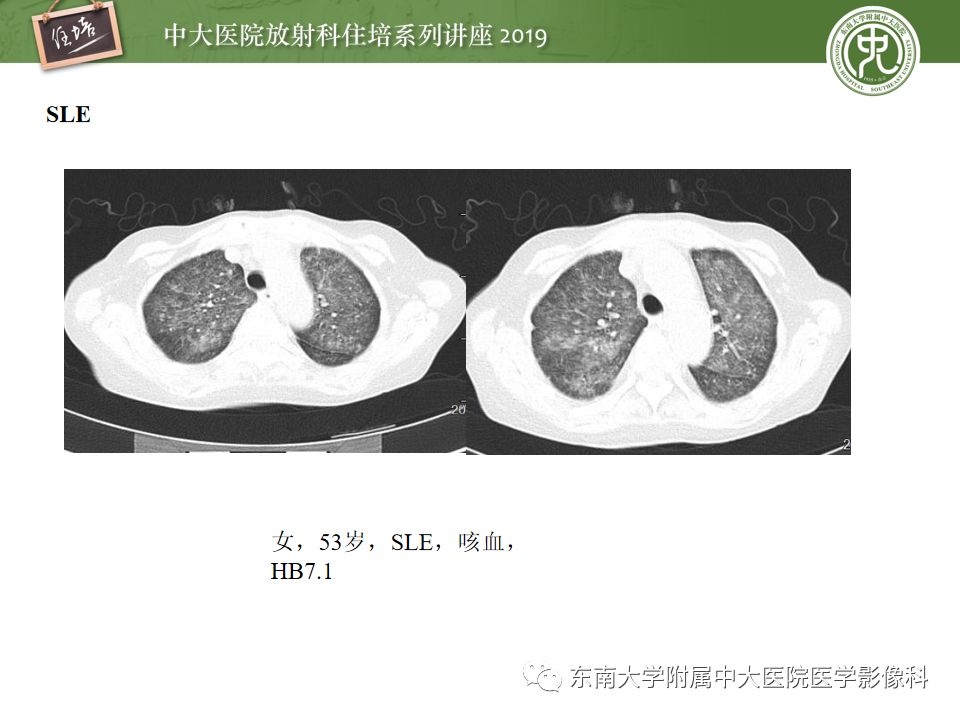 【PPT】咯血的临床及影像分析思路