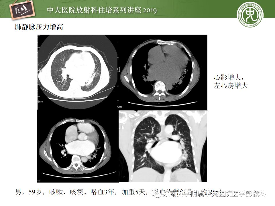 【PPT】咯血的临床及影像分析思路