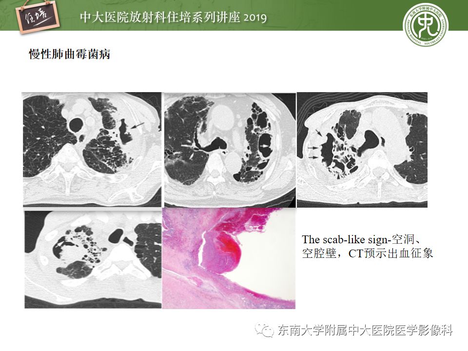 【PPT】咯血的临床及影像分析思路