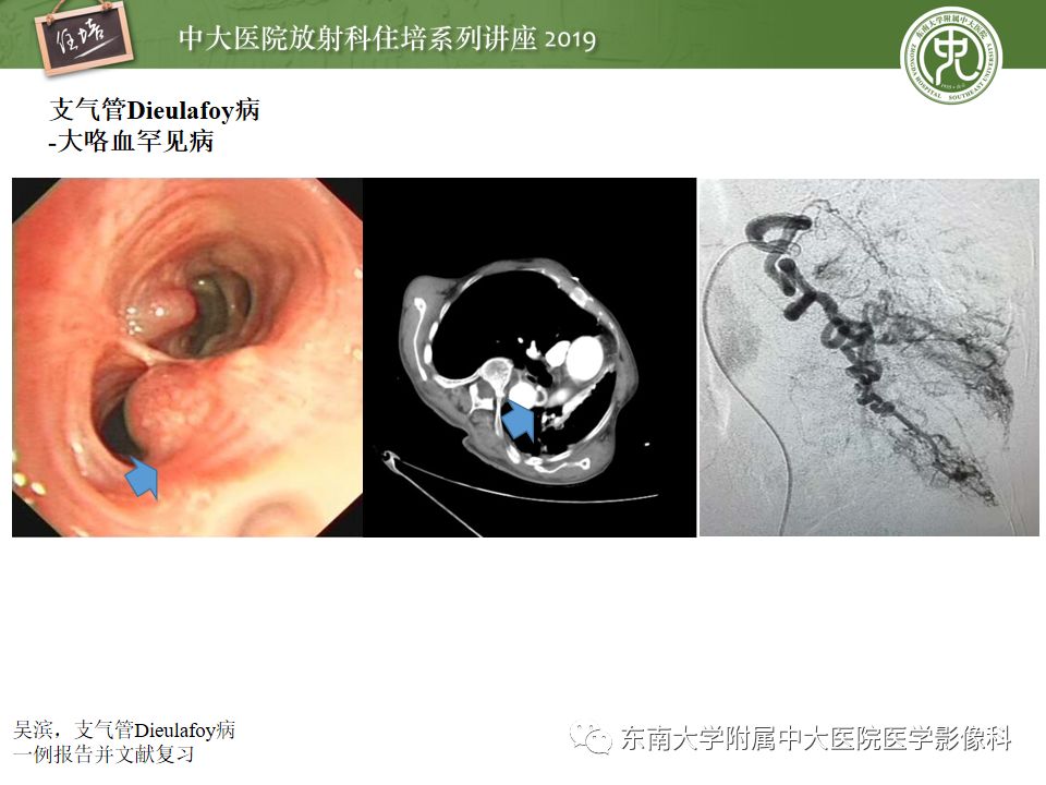 【PPT】咯血的临床及影像分析思路