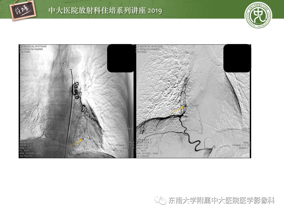 【PPT】咯血的临床及影像分析思路