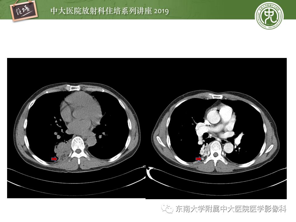 【PPT】咯血的临床及影像分析思路
