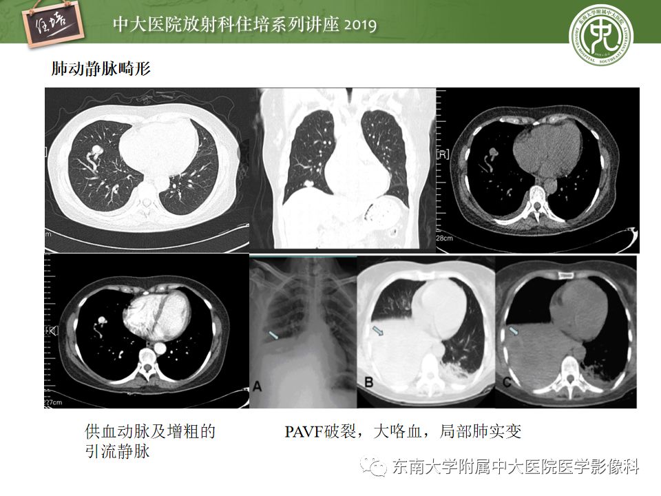 【PPT】咯血的临床及影像分析思路