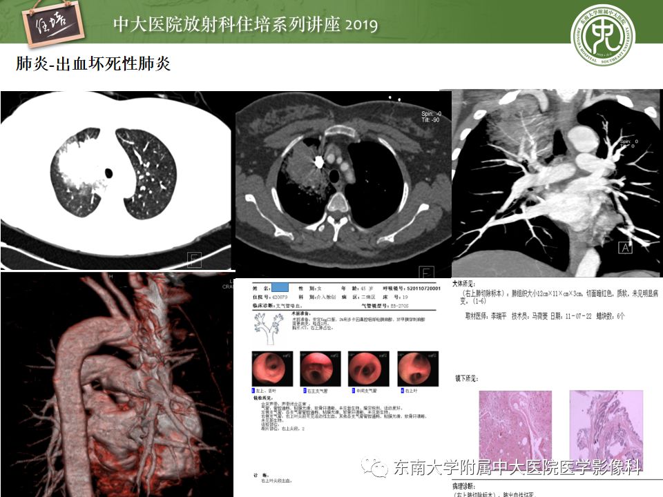 【PPT】咯血的临床及影像分析思路