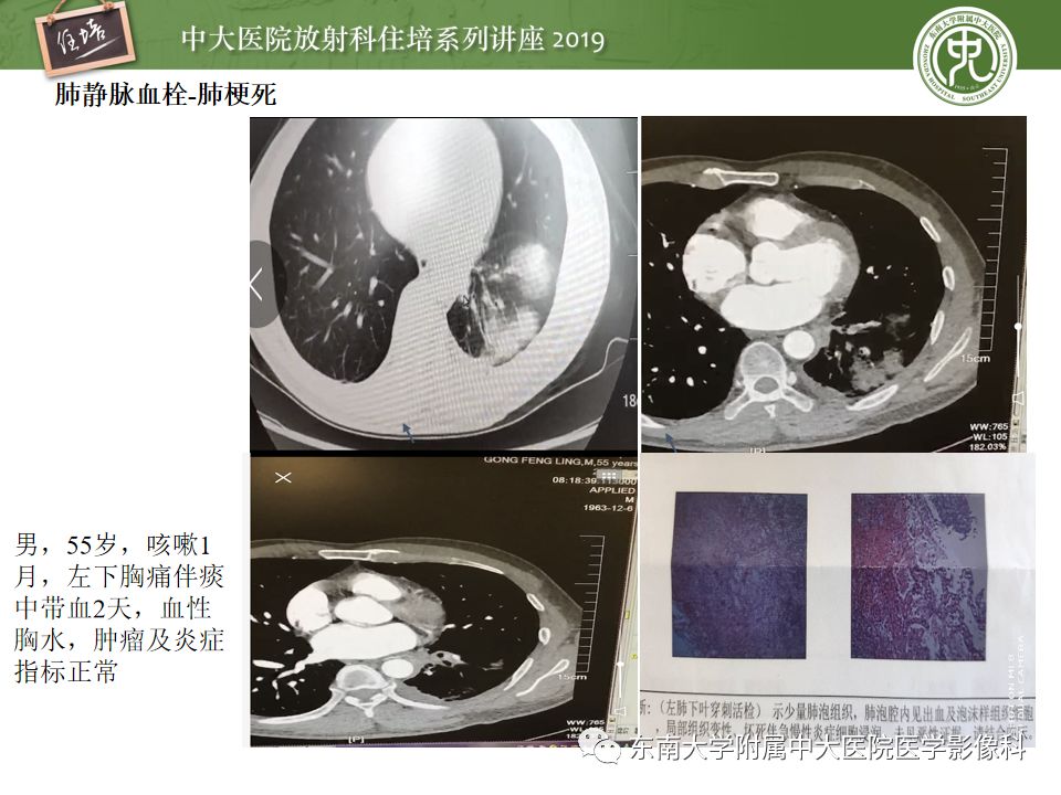 【PPT】咯血的临床及影像分析思路