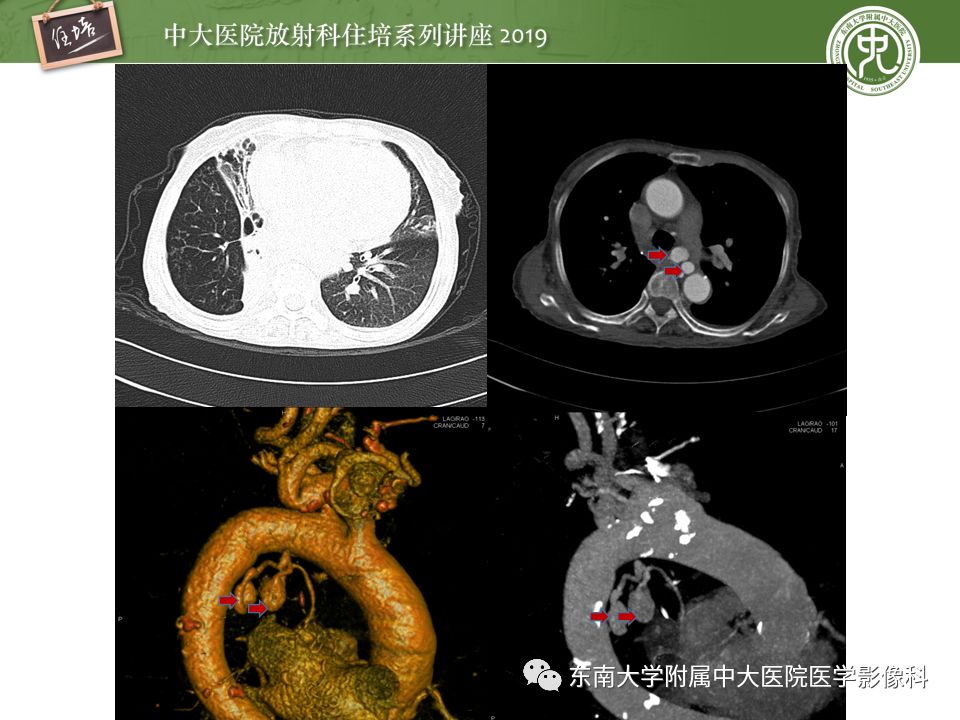 【PPT】咯血的临床及影像分析思路