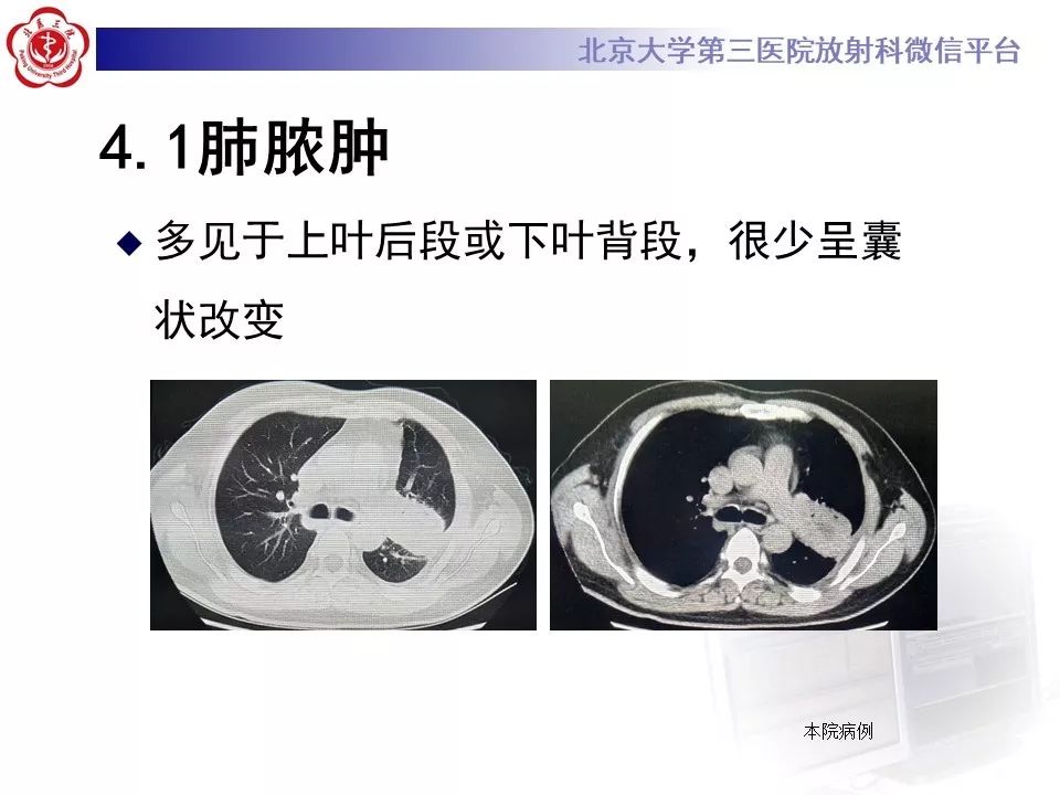 【PPT】肺隔离症的影像