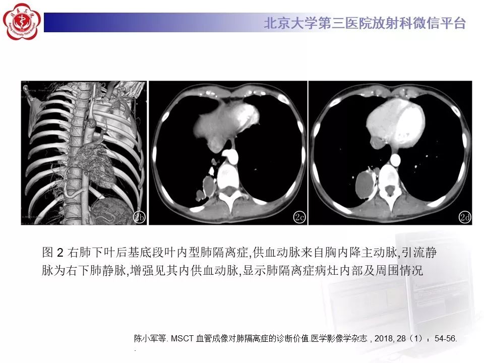 【PPT】肺隔离症的影像