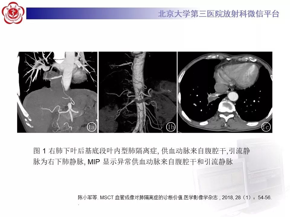 【PPT】肺隔离症的影像
