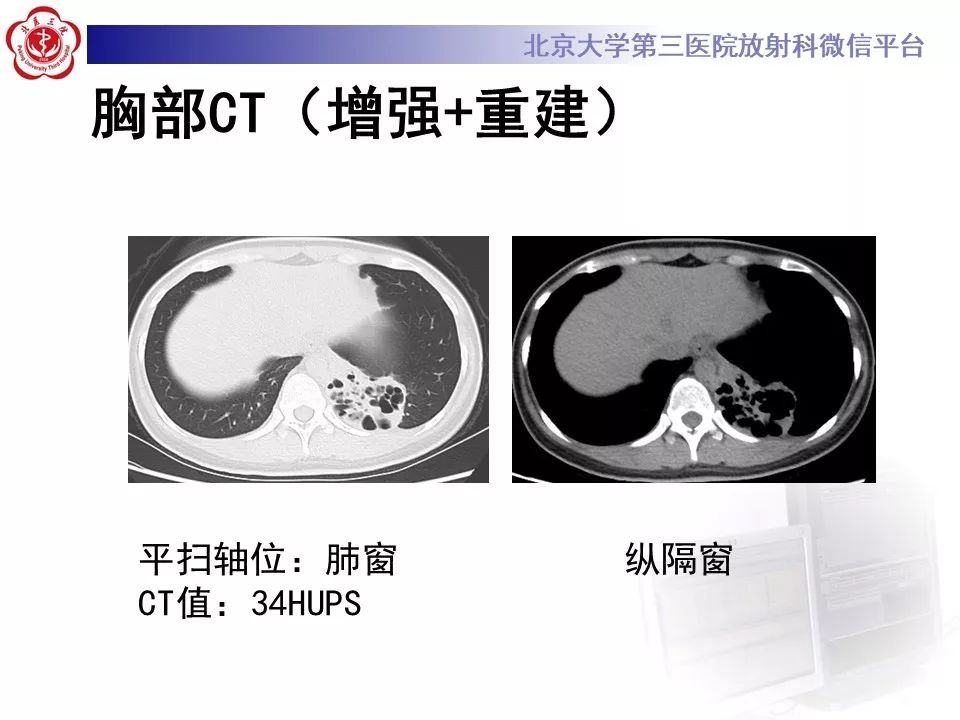 【PPT】肺隔离症的影像