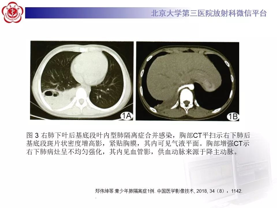 【PPT】肺隔离症的影像