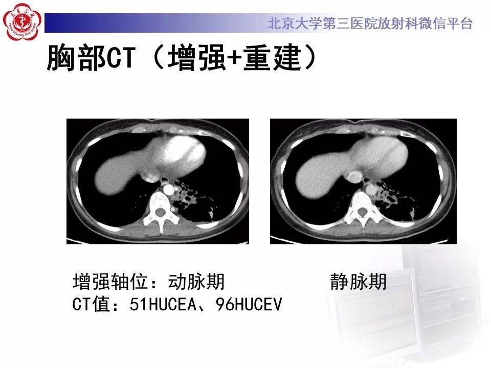 【PPT】肺隔离症的影像