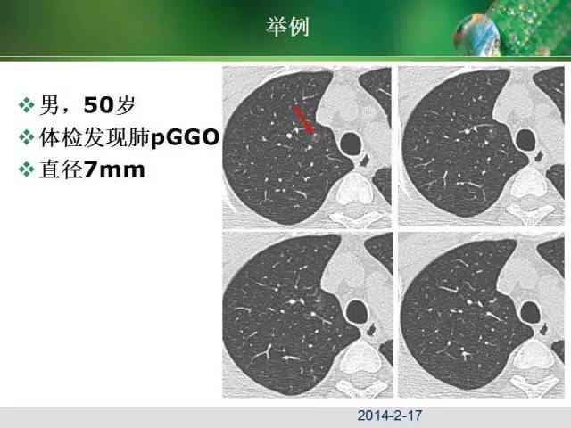 【PPT】肺磨玻璃密度阴影(GGO) 的CT诊断与处理