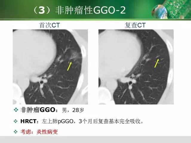 【PPT】肺磨玻璃密度阴影(GGO) 的CT诊断与处理