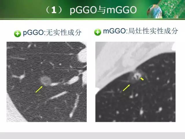 【PPT】肺磨玻璃密度阴影(GGO) 的CT诊断与处理 【PPT】肺磨玻璃密度阴影(GGO) 的CT诊断与处理