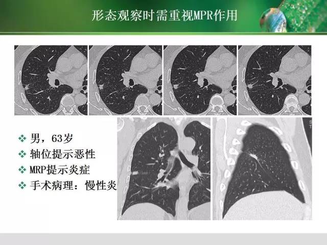 【PPT】肺磨玻璃密度阴影(GGO) 的CT诊断与处理