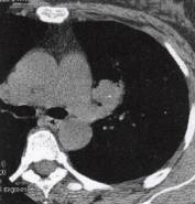 “分叶征” 的影像表现与临床意义