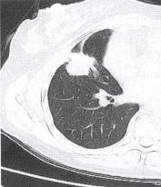 “分叶征” 的影像表现与临床意义