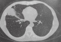 “分叶征” 的影像表现与临床意义