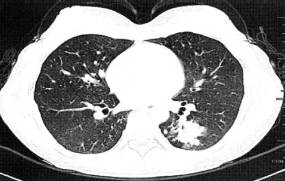 “分叶征” 的影像表现与临床意义