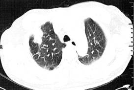 “分叶征” 的影像表现与临床意义