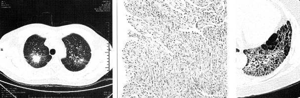 “分叶征” 的影像表现与临床意义