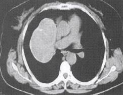 “分叶征” 的影像表现与临床意义
