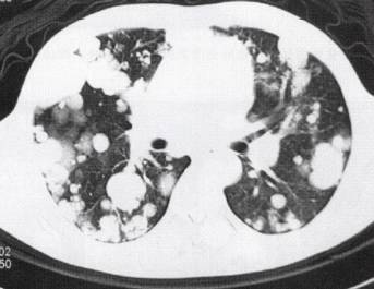“分叶征” 的影像表现与临床意义