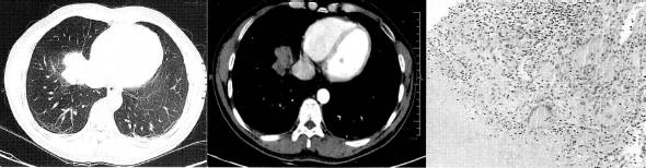 “分叶征” 的影像表现与临床意义