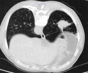 “分叶征” 的影像表现与临床意义