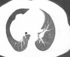 “分叶征” 的影像表现与临床意义