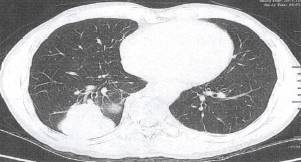 “分叶征” 的影像表现与临床意义