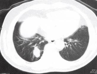 “分叶征” 的影像表现与临床意义