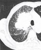 “分叶征” 的影像表现与临床意义