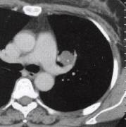 “分叶征” 的影像表现与临床意义