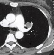 “分叶征” 的影像表现与临床意义