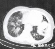 “空气支气管征” 的影像表现与临床意义